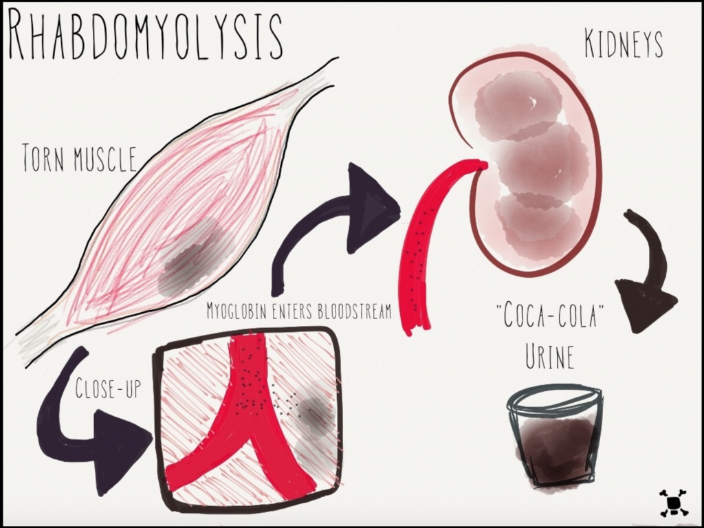 The dreaded rhabdomyolysis