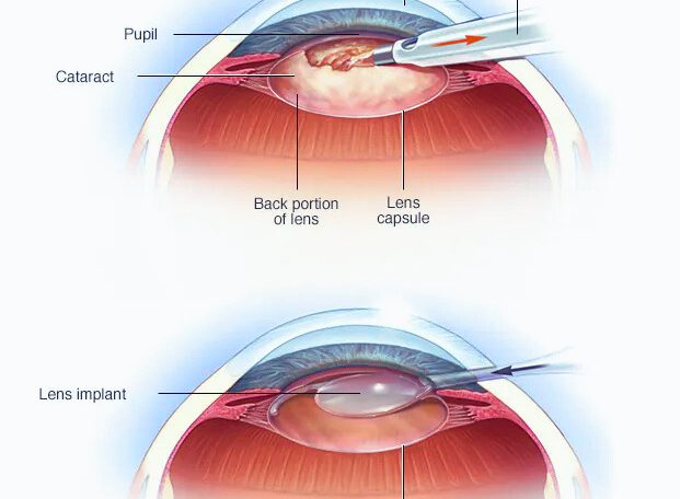 My Cataract Surgery Journey: Learning to See Clearly Again